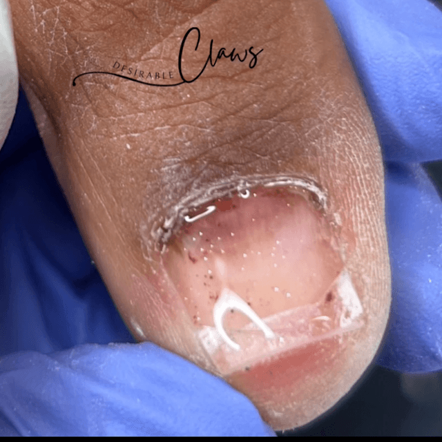 Anti-Fungal Care at Desirable Clawz Nail & Feet Boutique in Hampton, GA